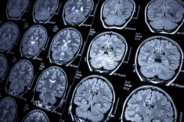 Brain Tumor Classification